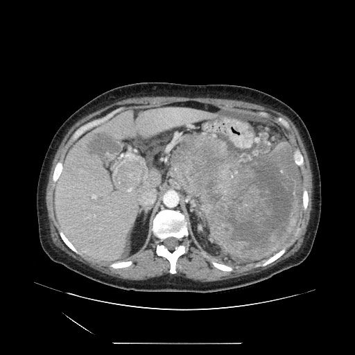 Acinar cell carcinoma of the pancreas (Radiopaedia 75442-86669 Axial C+ portal venous phase 39).jpg