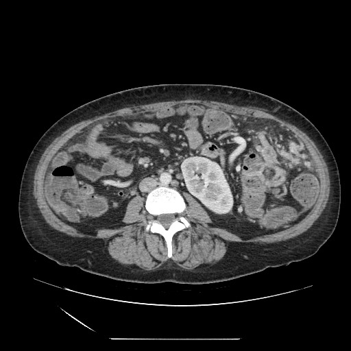 Acinar cell carcinoma of the pancreas (Radiopaedia 75442-86669 Axial C+ portal venous phase 80).jpg