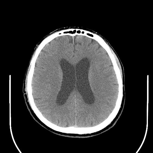 File:Acoustic schwannoma (Radiopaedia 39170-41388 Axial non-contrast 31).png