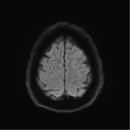 Acoustic schwannoma (Radiopaedia 50846-56358 Axial DWI 53).png