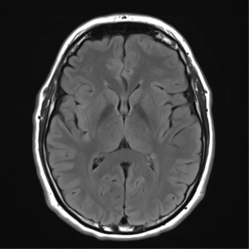 File:Acoustic schwannoma (Radiopaedia 50846-56358 Axial FLAIR 17).png