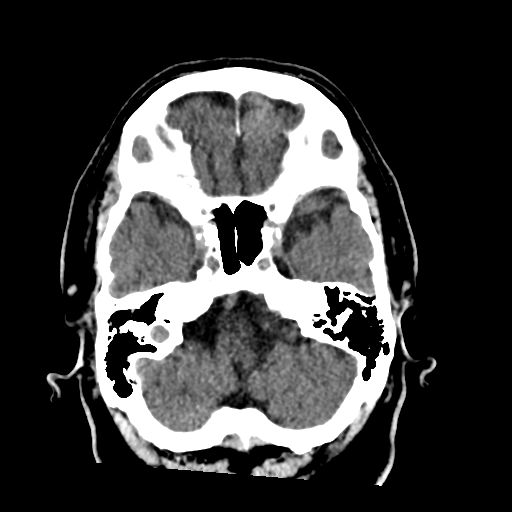 File:Acoustic schwannoma (Radiopaedia 55729-62280 Axial non-contrast 9).png