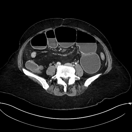 Active Crohn disease (Radiopaedia 59394-66750 Axial C+ portal venous phase 47).jpg
