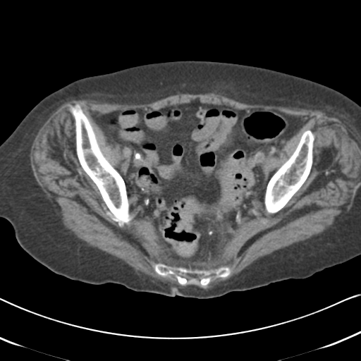 Active bleeding from duodenal ulcer with embolization (Radiopaedia 34216-35481 Axial non-contrast 55).png