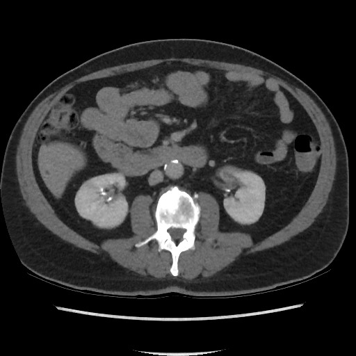File:Active colonic bleed on CT (Radiopaedia 49765-55025 Axial C+ delayed 38).jpg