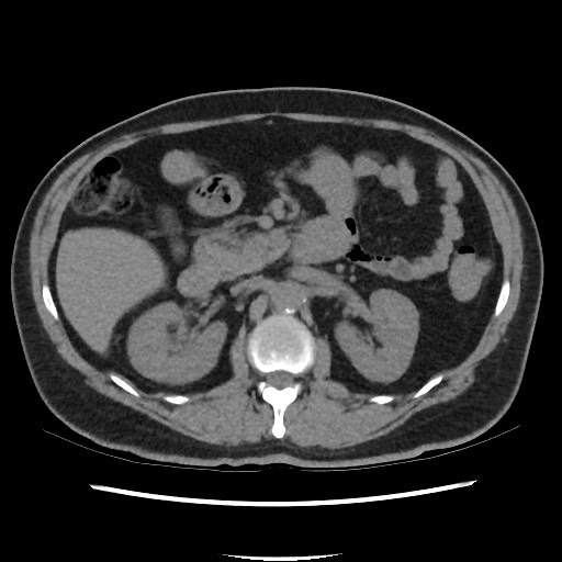 Active colonic bleed on CT (Radiopaedia 49765-55025 Axial non-contrast 30).jpg