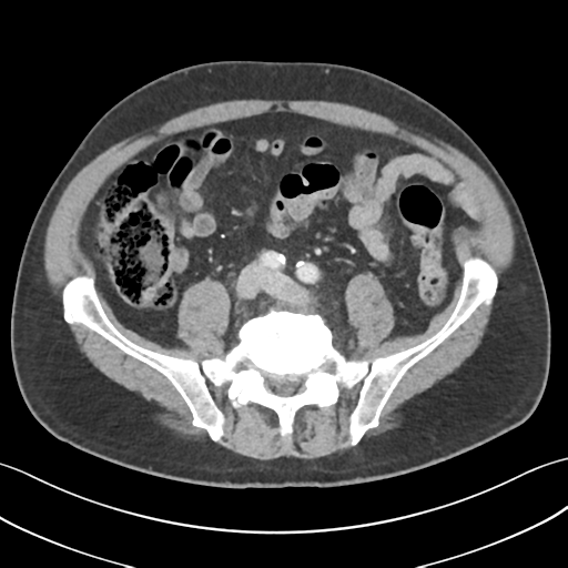 File:Active diverticular hemorrhage (Radiopaedia 39415-41725 Axial C+ portal venous phase 44).png