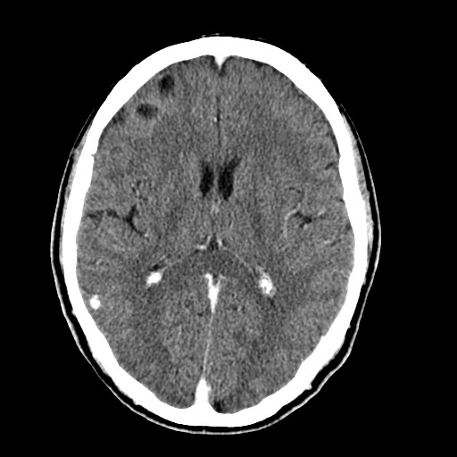 File:Active neurocysticercosis before and after therapy (Radiopaedia 71710-82099 Axial C+ delayed 46).jpg