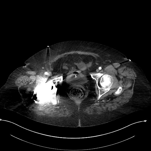 Active renal extravasation with large subcapsular and retroperitoneal hemorrhage (Radiopaedia 60975-68796 Axial C+ arterial phase 188).jpg
