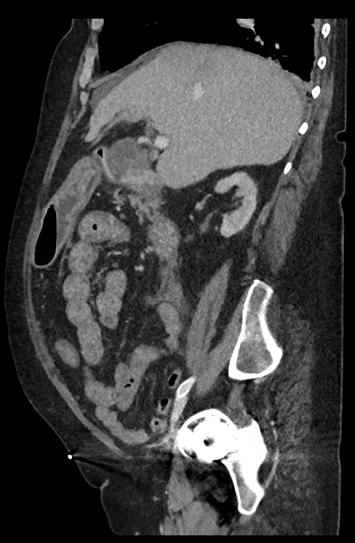 Active renal extravasation with large subcapsular and retroperitoneal hemorrhage (Radiopaedia 60975-68796 Sagittal C+ portal venous phase 146).jpg