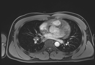 File:Active right ventricular cardiac sarcoidosis (Radiopaedia 55596-62100 Axial Post contrast Dixon 39).jpg