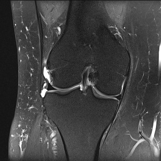 File:Acute-on-chronic transient lateral patellar dislocation with trochlear dysplasia (Radiopaedia 84099-99349 Coronal PD fat sat 19).jpg