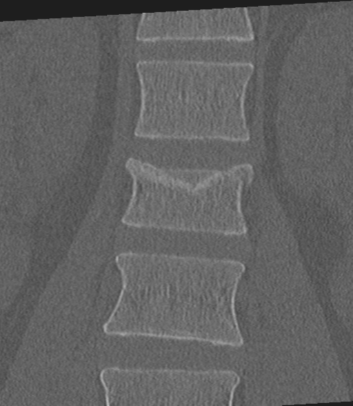Acute L1 burst compression fracture (Radiopaedia 34430-35755 Coronal bone window 22).png