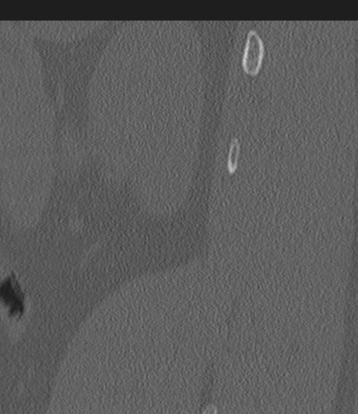 Acute L1 burst compression fracture (Radiopaedia 34430-35755 Sagittal bone window 63).png