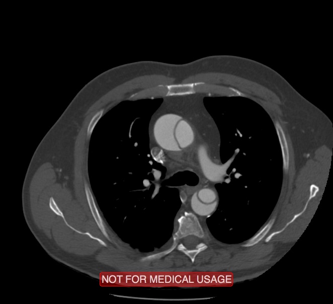Acute aortic dissection - Stanford type A (Radiopaedia 40661-43285 Axial C+ arterial phase 17).jpg