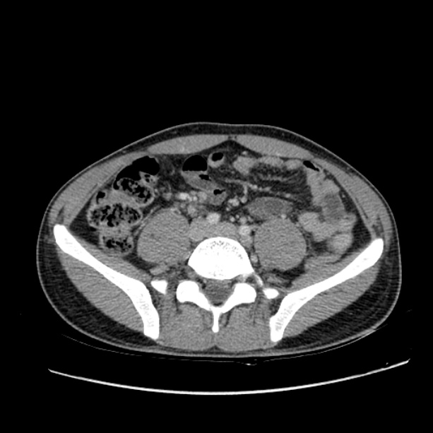 Acute appendicitis (Radiopaedia 27049-27227 Axial C+ portal venous phase 48).jpg
