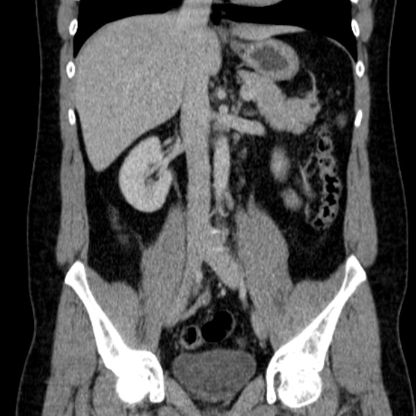 Acute appendicitis (Radiopaedia 38255-40270 Coronal C+ portal venous phase 46).jpg