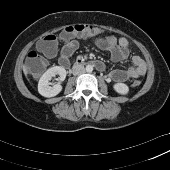 Acute appendicitis (Radiopaedia 48792-53822 Axial C+ portal venous phase 58).jpg