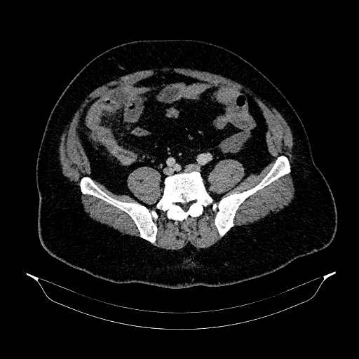 Acute appendicitis (Radiopaedia 79950-93224 Axial C+ portal venous phase 73).jpg