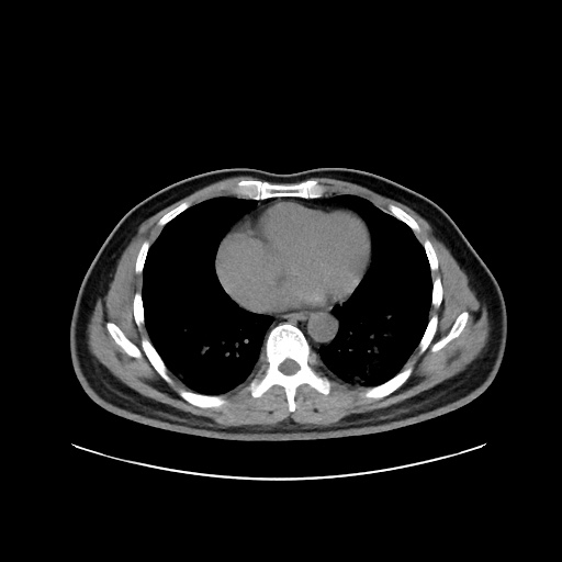 Acute appendicitis and COVID 19 pneumonia (Radiopaedia 76604-88380 Axial non-contrast 35).jpg