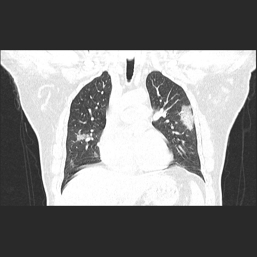 Acute appendicitis and COVID 19 pneumonia (Radiopaedia 76604-88380 G 28).jpg