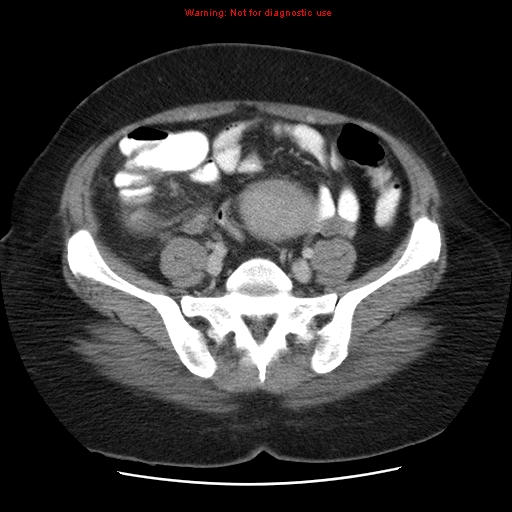 File:Acute appendicitis complicated by ovarian vein thrombophlebitis (Radiopaedia 16172-15851 Axial C+ portal venous phase 67).jpg
