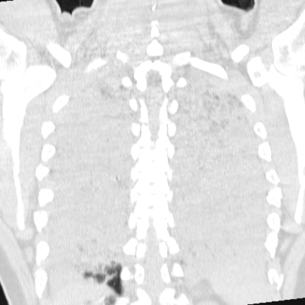 Acute aspiration pneumonitis (Radiopaedia 33605-34703 Coronal lung window 63).jpg
