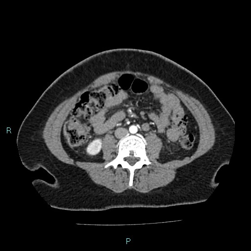 Acute bilateral pyelonephritis (Radiopaedia 37146-38881 Axial C+ arterial phase 110).jpg