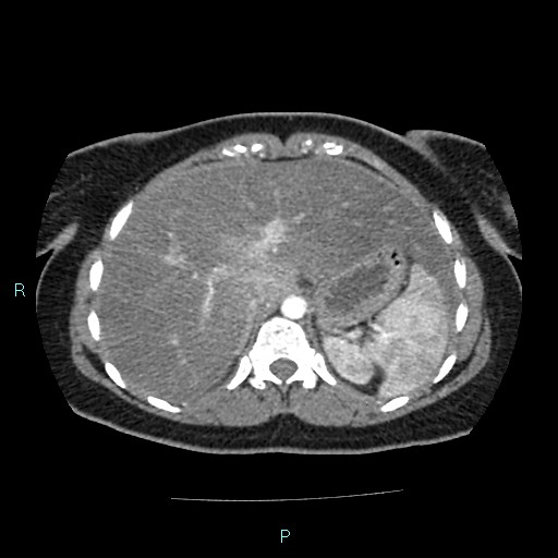 Acute bilateral pyelonephritis (Radiopaedia 37146-38881 Axial C+ arterial phase 33).jpg
