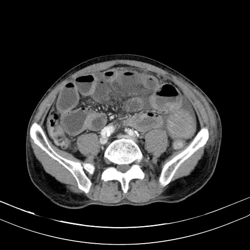 Acute bowel ischemia (Radiopaedia 87695-104114 Axial C+ portal venous phase 58).jpg