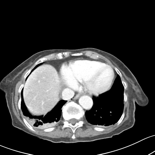 Acute cholecystitis with contained perforation (Radiopaedia 47328-51907 Axial C+ portal venous phase 8).png