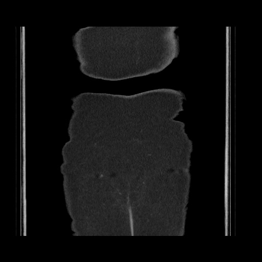 Acute cholecystitis with tensile fundus sign (Radiopaedia 71394-81723 Coronal non-contrast 124).jpg