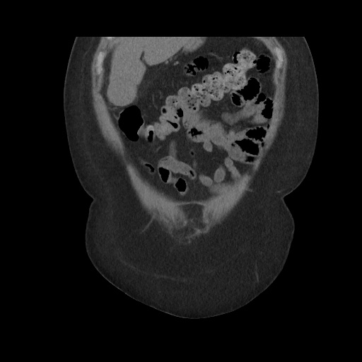 Acute cholecystitis with tensile fundus sign (Radiopaedia 71394-81723 Coronal non-contrast 33).jpg