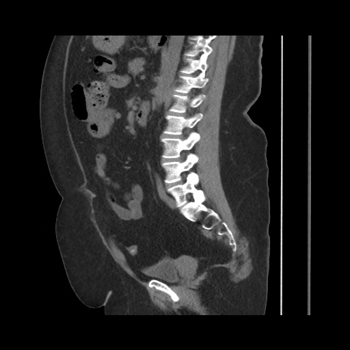 Acute cholecystitis with tensile fundus sign (Radiopaedia 71394-81723 Sagittal non-contrast 97).jpg