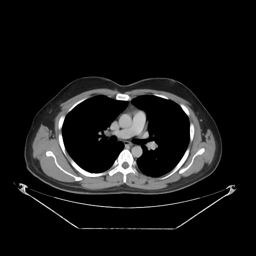 File:Acute complicated calculous cholecystitis (Radiopaedia 55202-61587 Axial C+ delayed 1).jpg