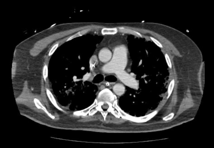 Acute cor pulmonale (ultrasound) (Radiopaedia 83508-98818 Axial C+ CTPA 30).jpg