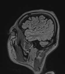 Acute disseminated encephalomyelitis (ADEM)- Anti-NMDA receptor encephalitis (Radiopaedia 54920-61201 Sagittal FLAIR 68).png