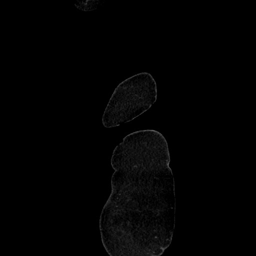 Acute diverticulitis - transverse colon (Radiopaedia 87063-103327 Sagittal C+ portal venous phase 14).jpg