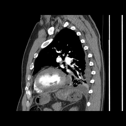 Acute epicardial fat necrosis (Radiopaedia 42327-45440 Sagittal C+ CTPA 48).jpg