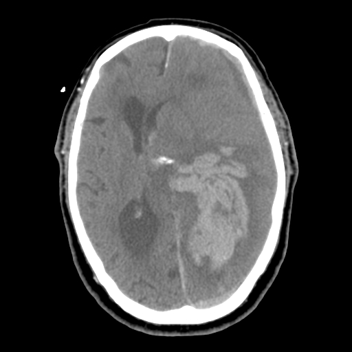 Acute hemorrhagic stroke (Radiopaedia 17507-17223 Axial non-contrast 28).jpg