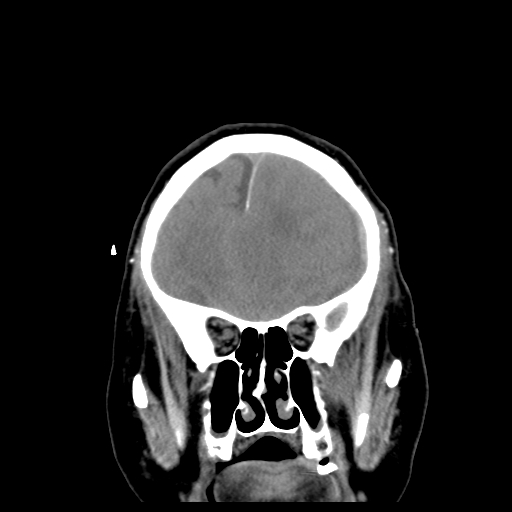 Acute hemorrhagic stroke (Radiopaedia 17507-17223 Coronal non-contrast 13).jpg
