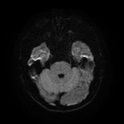 Acute internal carotid artery dissection (Radiopaedia 53541-59632 Axial DWI 9).jpg