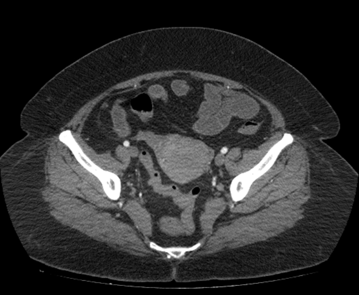 Acute mesenteric ischemia (Radiopaedia 80029-93316 Axial C+ arterial phase 110).jpg