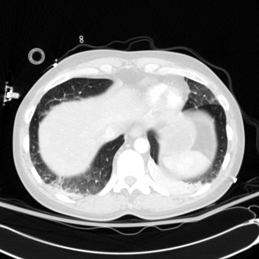 Acute myocardial infarction in CT (Radiopaedia 39947-42415 Axial lung window 112).jpg