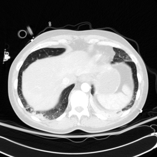 File:Acute myocardial infarction in CT (Radiopaedia 39947-42415 Axial lung window 115).jpg