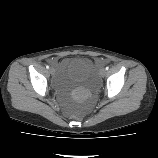 Acute myocarditis (Radiopaedia 55988-62613 Axial C+ portal venous phase 71).jpg