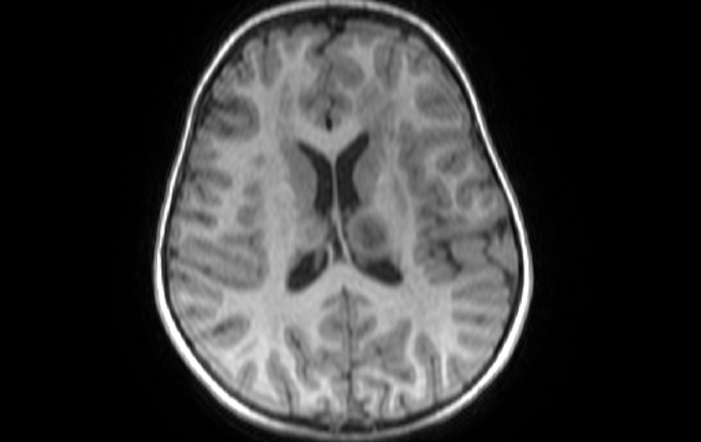 Acute necrotizing encephalitis of childhood (Radiopaedia 67356-76737 Axial T1 37).jpg