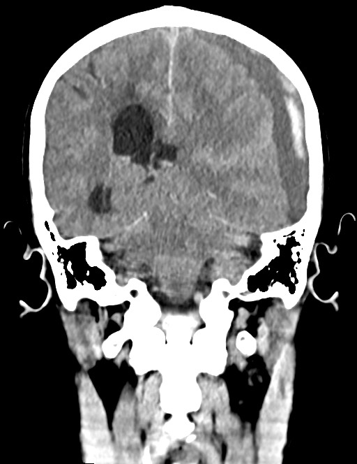 Acute on chronic subdural hematoma (Radiopaedia 74814-85823 Coronal non-contrast 41).jpg