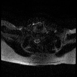 Acute otitis externa (Radiopaedia 57296-64236 Axial DWI 60).jpg