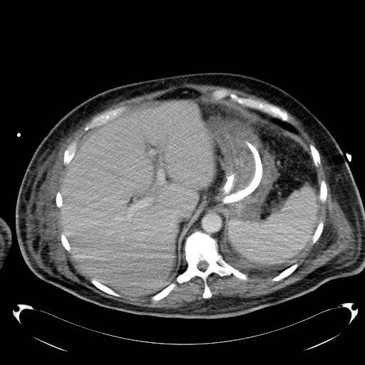 Acute pancreatic necrosis (Radiopaedia 13560-18503 Axial C+ portal venous phase 15).jpg